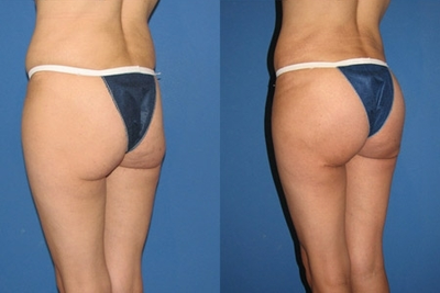 Butt Lift - Butt Lift