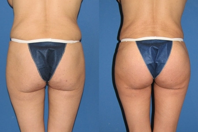 Butt Lift - Butt Lift