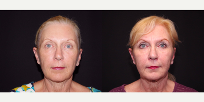 55-64 year old woman treated with Bellafill - 64 year old female received Bellafill to the nasolabial folds and marionettes; photos depict the patient's results 4 months post-treatment.