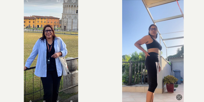 45-54 year old woman treated with Endoscopic Sleeve Gastroplasty - Gastric sleeve Surgery with 1 year dietitation follow
