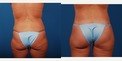 35-44 year old woman treated with Butt Lift - Circumferential Abdominoplasty with Auto Buttock Augmentation