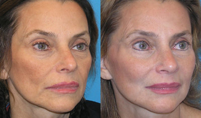 Midfacial Rejuvenation - 
	Midface lifting in an endoscopic technique used to rejuvinate the area between the lower eyelid and the corner of the mouth. Incorporating this procedure into a surgical plan helps to create a balanced result, as seen in this patient. Lower eyelid blepharoplasty, endoscopic midface lift, and a revision facelift were performed in this case.
