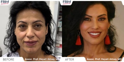 45-54 year old woman treated with Deep Plane Facelift, Facial Fat Transfer, Facelift, Neck Lift, Eyelid Surgery, Lip Lift - 45-54 year old woman treated with Deep Plane Facelift, Facial Fat Transfer, Facelift, Neck Lift, Eyelid Surgery, Lip Lift