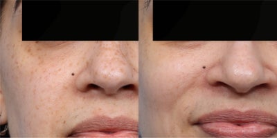 38 year old woman treated with PicoWay - This 38 year old female wanted to address concerns about hyperpigmentation and uneven skin tone. She underwent a Pico laser treatment to target pigmentation at multiple skin depths, improving clarity and overall radiance. The procedure helped break down excess pigment while stimulating collagen for smoother, brighter skin. At her follow-up, her complexion appeared more even, refreshed, and rejuvenated.
