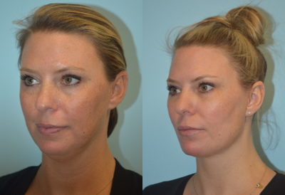 35-44 year old woman treated with ThermiSmooth Face - Patient was treated in the office with liposuction and Thermi RF to the lower face and jawline for a contoured, sculptured result.