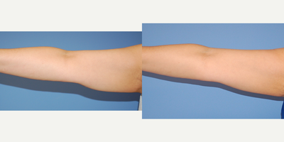 45-54 year old woman treated with SculpSure - treatment for arms