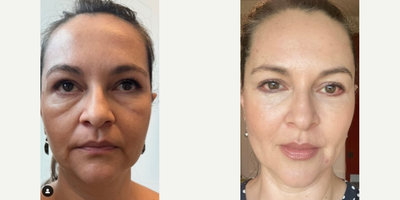 Woman treated with Halo Laser - This gorgeous patient of mine wanted a refreshed look without a facelift. We talked extensively and decided together a transconjunctival blepharoplasty with subperiosteal fat transposition, full facial fat grafting, and Halo laser resurfacing would meet her goals. Shes 5 weeks out and the results are only going to get better!