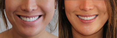 Lip Implant and Dimple Creation - Upper and lip implants are placed to give a natural, enhanced appearance.&nbsp;