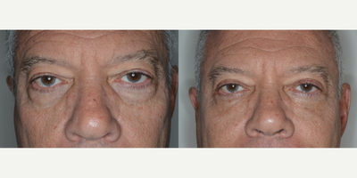 55-64 year old man treated with Eyelid Surgery - Dr. Anthony Bared performed eyelid blepharoplasty with fat re-positioning on this male patient.