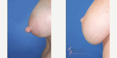 45-54 year old woman treated with Nipple Surgery - This 53 year old woman is seen 2 years after reduction of her prominent nipples. This was performed at the same time as her breast lift/reduction which removed 158 gm and 176 grams from the right and left breasts respectively. Scarring is excellent and all sensation has been preserved!