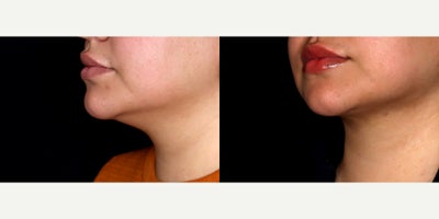 28 year old woman treated with Liposuction, chin Fat Transfer, PrecisionTx - 28 year old female treated with liposuction to the submental neck (double chin) and fat transfer to chin. Photos depict before and 3 weeks after surgery