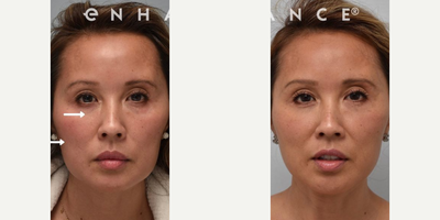 Woman treated with Cheekbone Reduction - This patient had fat grafting under her eyes and below the cheekbone. This gave her a more oval shape to her face and lifted her jowls without additional surgery. The arrows point to the areas with fat grafting.