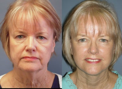 LiteLift, Liposuction on 65-year-old Woman - 
	The LiteLift is a modified facelift. It reduces signs of aging of the lower face, jaw line, and neck. Patients looking for affordable and quick facial rejuvenation should take a serious look at our LiteLift. The LiteLift can be performed in office under local anesthesia and uses long lasting techniques. Because the incisions are limited, there is less bruising, swelling and healing time for most patients.&nbsp;

