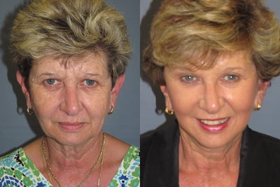 LiteLift, Blepharoplasty, Brow Lift on 57-year-old Woman - 
	This 57-year-old woman had a LiteLift, and lower Blepharoplasty and a Brow Lift. The Lite Lift (TM) is a modified facelift that can be performed in office under local anesthesia to improve signs of aging around the neck, jawline and lower face. Because of limited incisions there is little bruising and swelling and the recovery time is very quick, most patients can be back to work within two weeks. A Temple Lift helped to remove deeper lines in the forehead area.&nbsp;
