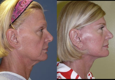 Revision of a poor facelift result. - Some people chose a sort of abbreviated facelift procedure. &nbsp;Some call it a mini lift, lunchtime lift, lifestyle lift and other names. &nbsp;Some surgeons will just tighten the skin a bit and eschew the deep muscle foundation, which puts too much tension on the skin closure. &nbsp;Then the scar can drift to a conspicuous location, well in front of the ear. &nbsp;Some people also get some hypo pigmentation or some hyper pigmentation. &nbsp;It is important to address the muscle beneath the lift, for a two layer repair that will hold up for a decade or two. &nbsp;