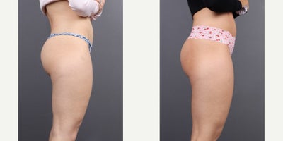 Woman treated with Sculptra Butt Lift, Nonsurgical Butt Lift - Consider non-surgical BBLs for a subtle enhancement.
