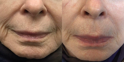 75 and up year old woman treated with Infini RF - This is a 79 year old woman who had a series of 3 monthly Microneedling with Radiofrequency to the lines around the mouth and cheeks. Minimal downtime unlike ablative laser resurfacing. Can be done again in six months.