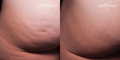 25-34 year old woman treated with Cellfina - 28-year-old female patient treated for cellulite on buttocks.