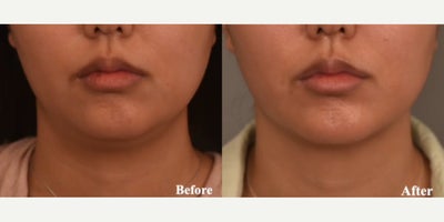 Woman treated with Smart Lipo - Woman treated with Smart Lipo in the chin and neck region and Chin Implant