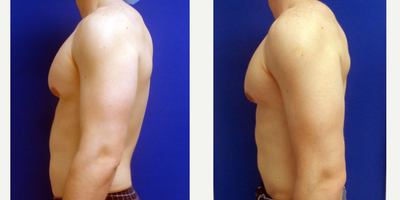 25-34 year old woman treated with Male Breast Reduction - Gynecomastia