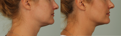 32 year old woman treated with Kybella - Treated submentum and jawline