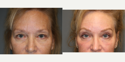 Enigmalift brow and upper eyelids. - Enigmalift to rejuvenate upper eyelids and brow with laser.