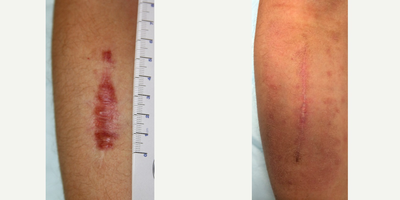 25-34 year old man treated with Scar Removal - Scar had been previously revised twice by another surgeon. I removed the scar and used Embrace scar gel for 8 weeks.