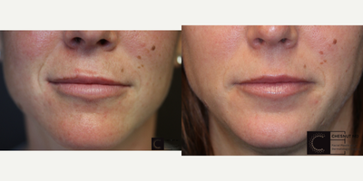 Hyaluronidase - Correction of uneven, unnatural lip filler.