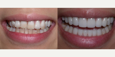 Nine porcelain veneers on her upper teeth and six veneers on the lower produced this result. - Patient didn't like the shape nor the color of her teeth. We decided to make her teeth more feminine as well as correct her issues. Nine porcelain veneers on her upper teeth and six veneers on the lower produced this result.