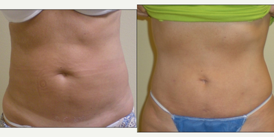 55-64 year old woman treated with Laser Liposuction Revision - Liposuction 3 years previous different Surgeon.  Minor contour irregularities.  Laser lipo revision performed.