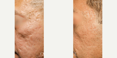 Acne Scars Combination Treatment with Subcision, CO2 Laser, TCA Cross by Dr. Qazi - Acne Scars Combination Treatment with Subcision, CO2 Laser, TCA Cross