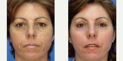 Woman in her 40s treated with Skin Tightening - Woman in her 40s treated with Skin Tightening using Micro Laser Peel