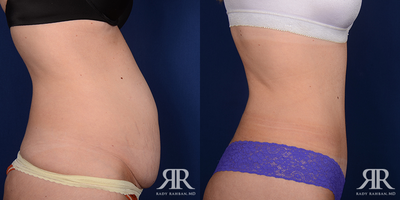 Tummy Tuck - Tummy Tuck