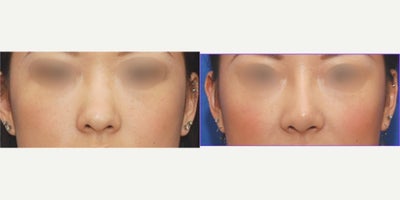 Asian Rhinoplasty, Rhinoplasty San Francisco, L Plastic Surgery by Charles K Lee - Female patient underwent Rhinoplasty in San Francisco, CA, by Dr. Charles Lee. The patient had an open rhinoplasty with a silicone implant and tip-plasty. Dr. Lee's meticulous technique and expertise shone through as the patient's nose was aesthetically improved, enhancing her facial harmony and lifting her nasal bone. The patient expressed gratitude for the positive experience and the skilled care received throughout the process, highlighting Dr. Lee's professionalism and the comforting environment of the clinic.