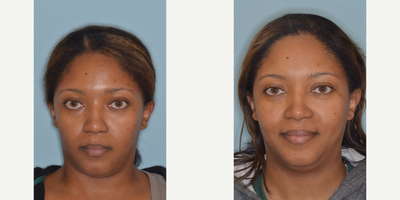 25-34 year old woman treated with Rhinoplasty - African American female patient came to Dr. Anthony Bared with a desire for more tip refinement. Operative techniques performed by Dr. Bared included nasal tip skin de-fatting, caudal septal extension graft, and tip shield graft. Base view demonstrates the change to a more pyramidal tip shape. 5 month post-operative results shown.