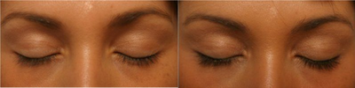 LATISSE - 
	Patient had average looking lashes which became much thicker and darker with Latisse.
