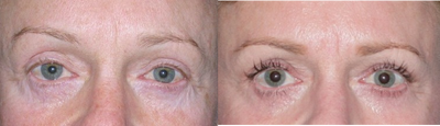 Latisse - 
	Patient&#39;s eyelashes before and after using Latisse.
