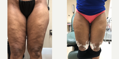 55-64 year old woman treated with Cellulaze - After one treatment for cellulite with Cellulaze procedure.