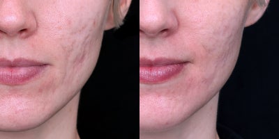 35-44 year old woman treated for Acne scars - This patient presented for acne scar treatment. This patient underwent Fractional CO2 laser resurfacing, Fraxel 1550nm laser, Morpheus8 RF microneedling, BellaFill semi-permanent filler injections & subcision, and sculptra injections.