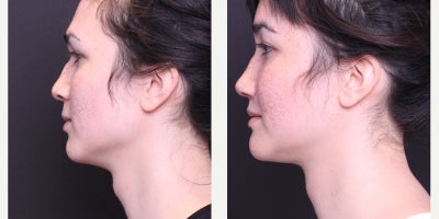 25-34 year old transgender woman treated with Facial Feminization Surgery, Adam's Apple Reduction - Thyroplasty, AFG to Face, Browbone Reduction, Browlift, Hairline Advancement, Rhinoplasty, Liplift, Mandible/Chin Contouring, Sliding Genioplasty, Submental Liposuction