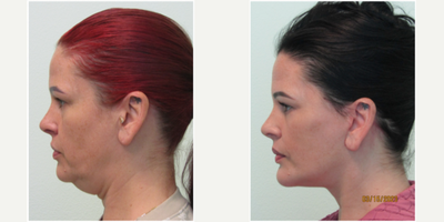 48 year old woman treated with SMAS Facelift, Neck Lift, Chin Implant, & Lower Eyelid Surgery - This woman presented with 2 primary concerns. Her first concern was in regards to her lack of profile and the excess tissue and fullness under her chin. Her second concern was regarding the chronic under eye bags that were persistent since her mid-30's.We decided together to perform a lower facelift and necklift along with placement of a silicone chin implant and a lower blepharoplasty to remove the eye bags. All procedures were performed in our Center under local anesthesia and oral sedation with xanax. No general anesthesia or IV anesthesia was utilized.Her results are significant with major improvement in her profile and facial harmony/balance overall. Her eyebags were successfully removed creating for her a more awake and refreshed appearance.Total procedure time was slightly over 3 hours. Most of her sutures were removed on day 6. She returned to both work and exercise 12 days after her procedures.
