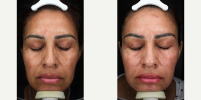 45-54 year old woman treated with Moxi - 2 MOXI Treatments
