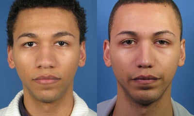 African American Rhinoplasty - 
	Example of African American rhinoplasty
