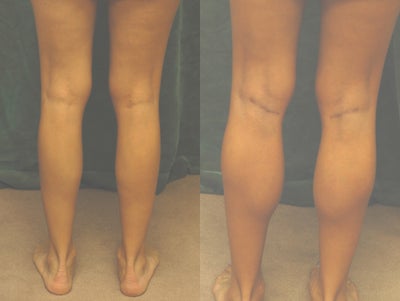 Men's Calf Augmentation   - Men's Calf Augmentation W/Implants:

	Incision placed in the back of the knee crease .

	Tear drop very soft silicon implant in sub-fascial level.