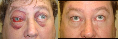 Orbital fracture repair - 
	This middle-age man suffered trauma to right eye, causing right orbital fracture with inability to look up. He underwent successful repair.
