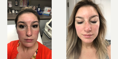 Woman treated with Vbeam - Woman treated with Vbeam