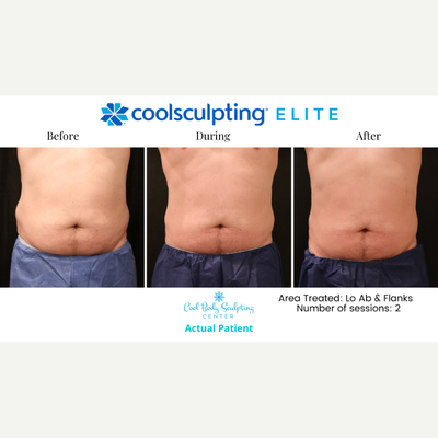 45-54 year old man treated with CoolSculpting Elite - CoolSculpting Elite on the low abdomen and flanks!