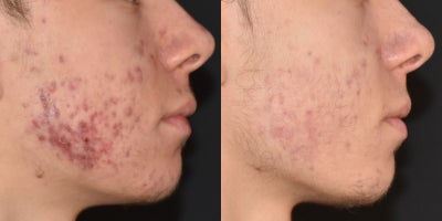 18-24 year old man treated with SkinPen - Combination of SkinPen Microneedling and Tretinoin
