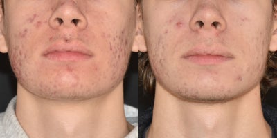 18-24 year old man treated with SkinPen - Combination of SkinPen Microneedling and Tretinoin