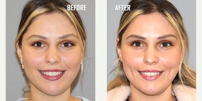25-34 year old woman treated with Dimple Surgery (Dimpleplasty) - Dimpleplasty
